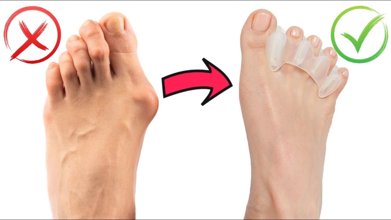 Toe Separator Introduction